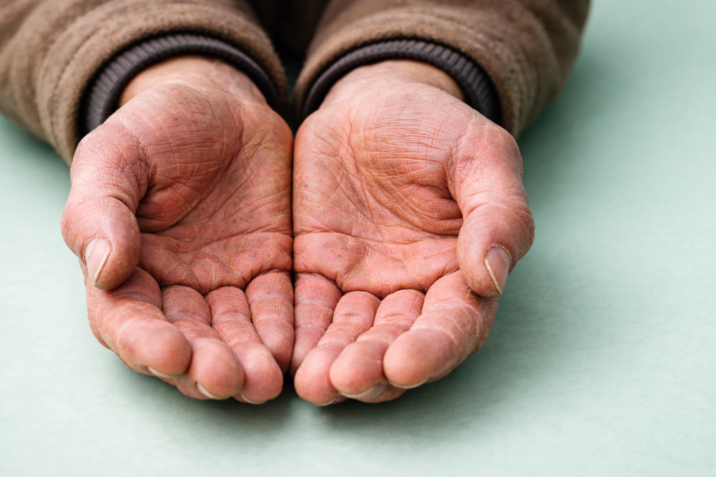 Mãos cuja pele se nota que está muito agredida pelo frio e trabalho físico.